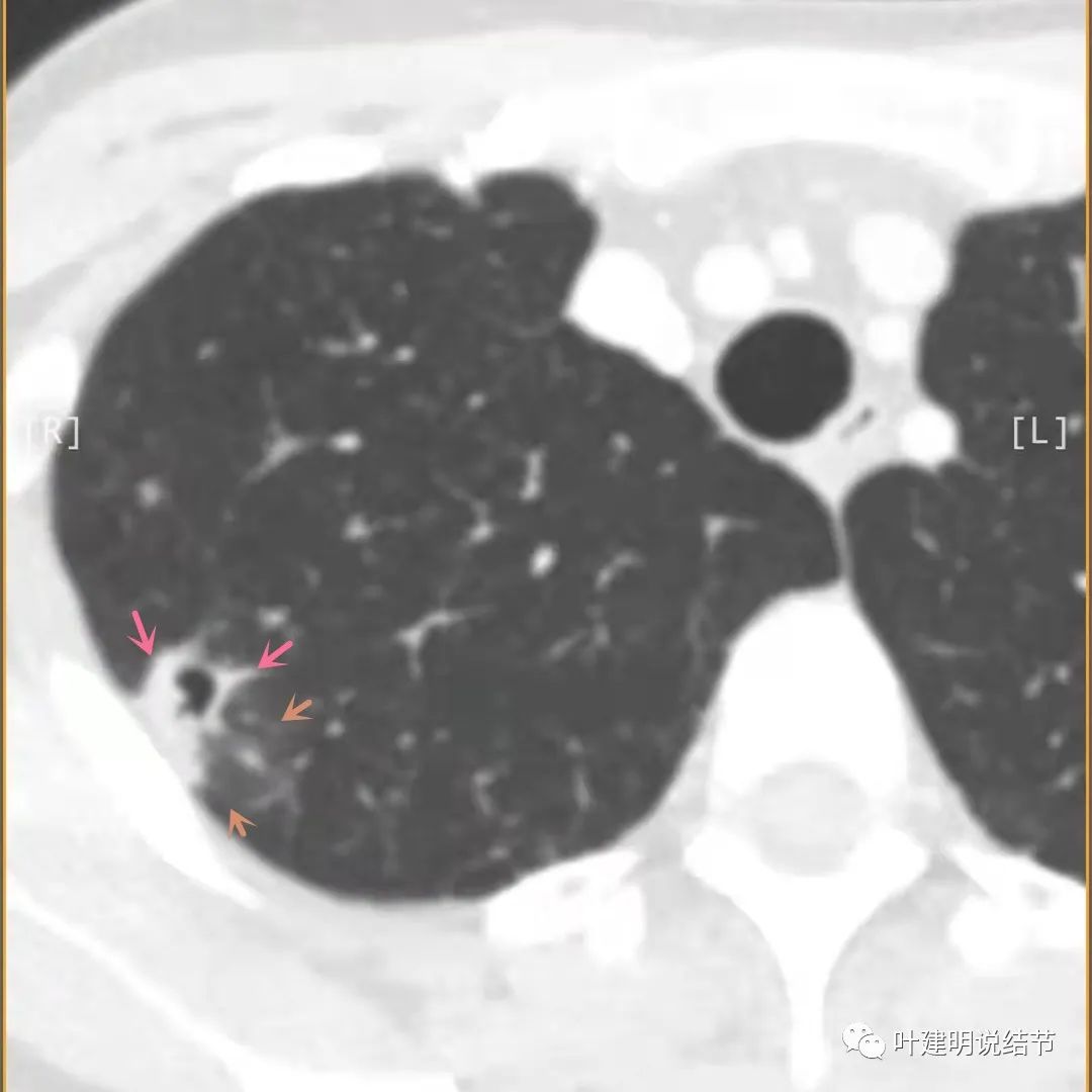 临床诊断孤立性肺结节,空洞型结节一般是什么性质