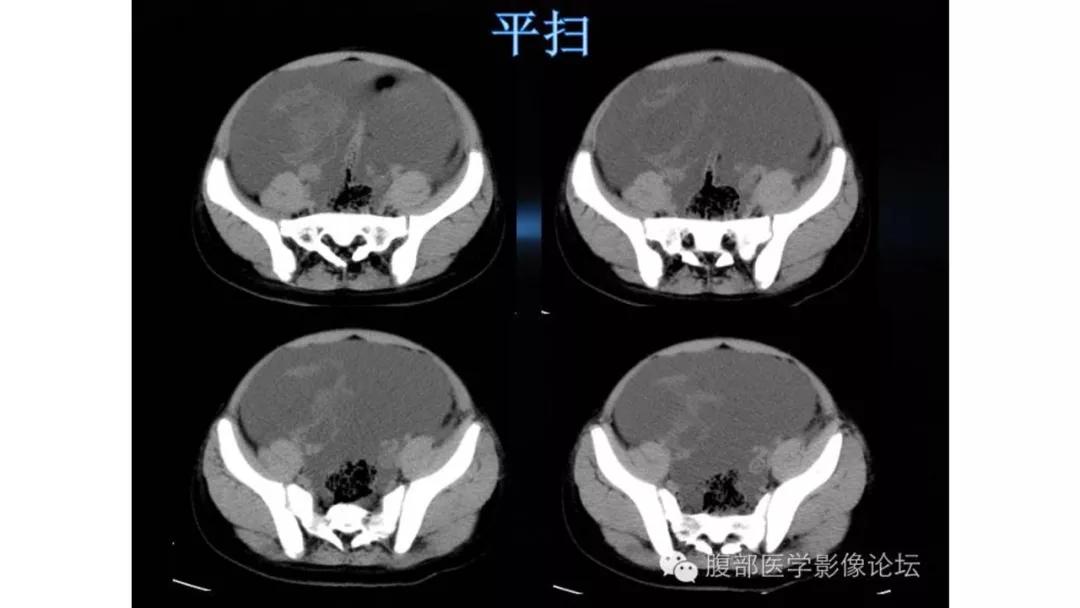 卵巢原发肿瘤的分析思路