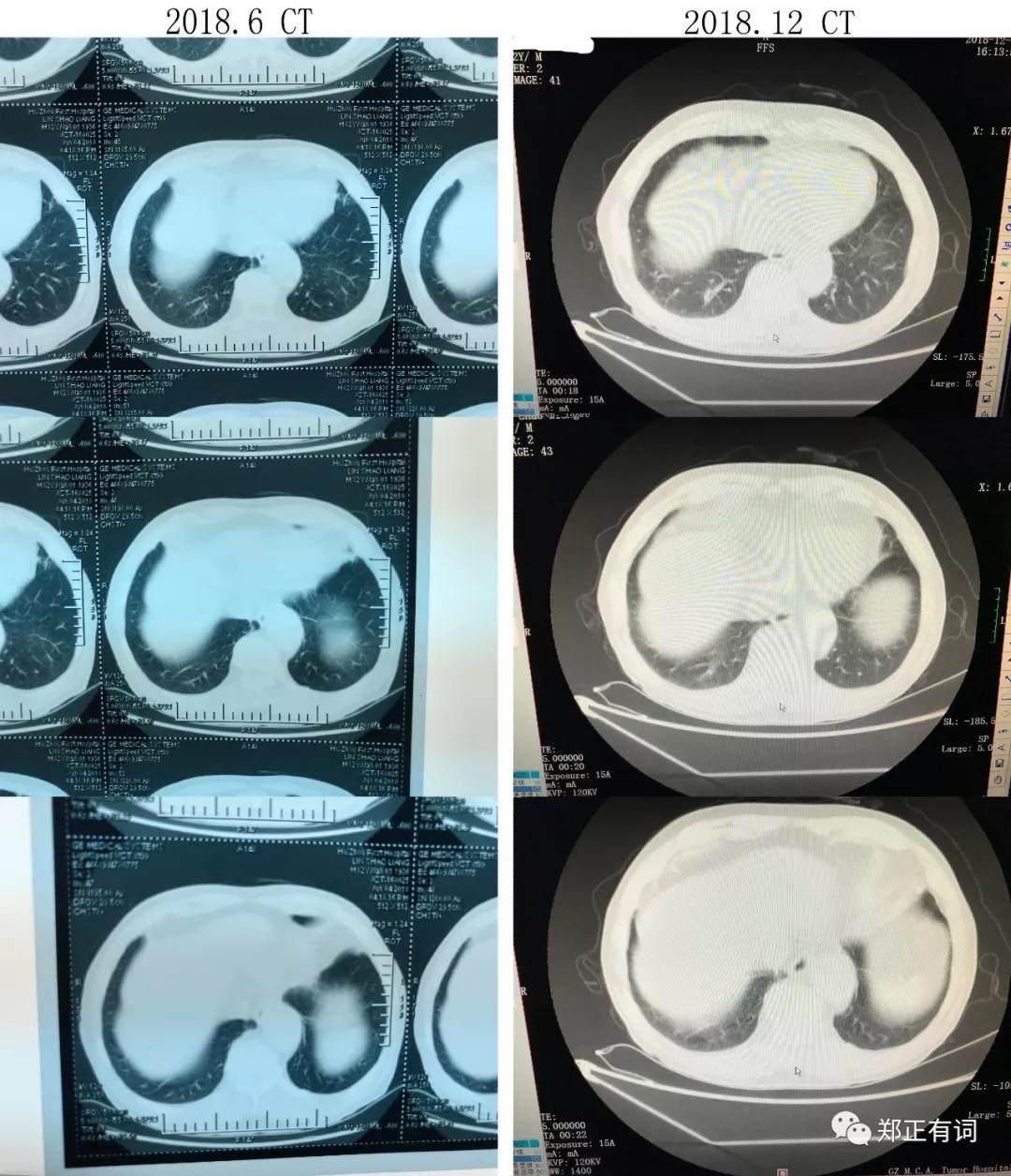 老年人肺癌不治疗能活多久,老年人得肺癌晚期不治疗能活多久