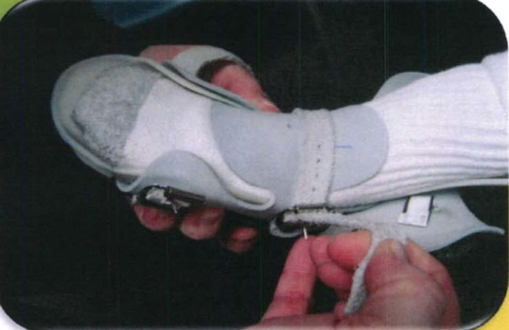 马蹄足畸形矫正案例,足踝部畸形矫正