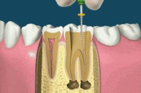 根管治疗为什么要做冠部修复,做完根管治疗以后不补会怎么样