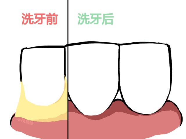 牙结石自己用手抠掉了,你用手抠过牙结石吗