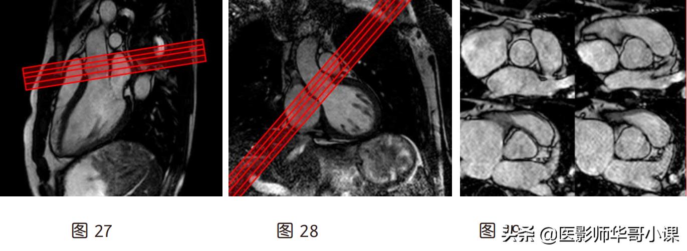 心脏mr增强扫描讲解,磁共振心脏扫描标准切面