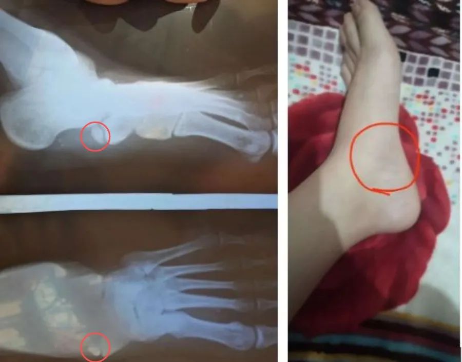 脚上多长了块骨头,腿关节多长了一块骨头