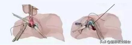 如何正确有效的缩小鼻翼,鼻翼大怎么缩小手术风险大吗