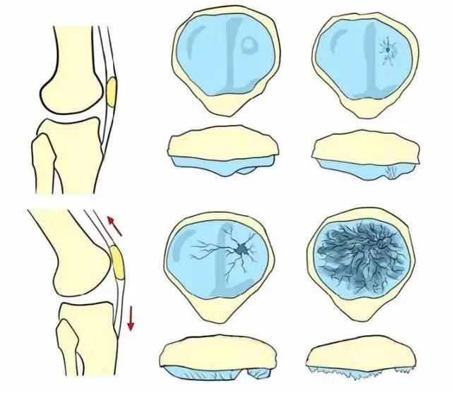 女排荣誉背后：郎平的髌骨被完全摘除！我们该怎么保护髌骨？