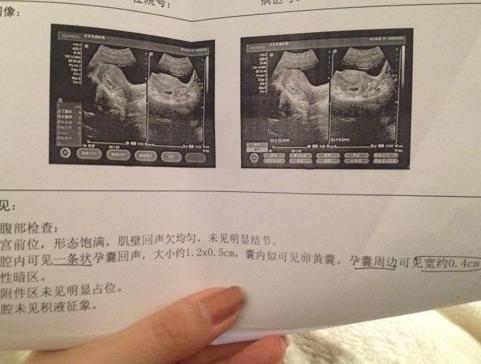 孕早期b超单子怎么看数据,孕早期b超单上怎么看数据