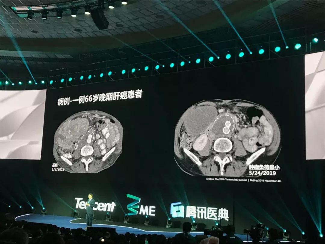 麻省总医院肝癌专家：早期肝癌可治愈，晚期肝癌很有希望