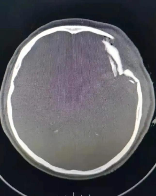 脑损伤新突破,重度颅脑损伤急救