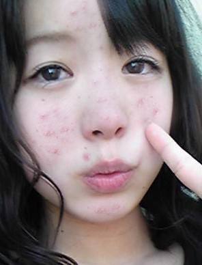 青春痘不多也不少需不需要去治疗,青春痘该治疗吗