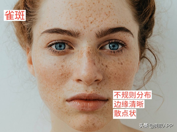 脸上有斑怎么祛斑最快最有效,脸上长斑点用什么药才能祛斑