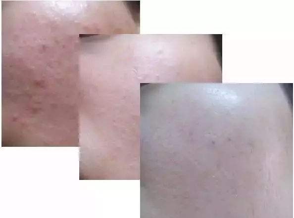 脸上痘印怎么最快淡化医美,夏季美白消痘印护脸霜