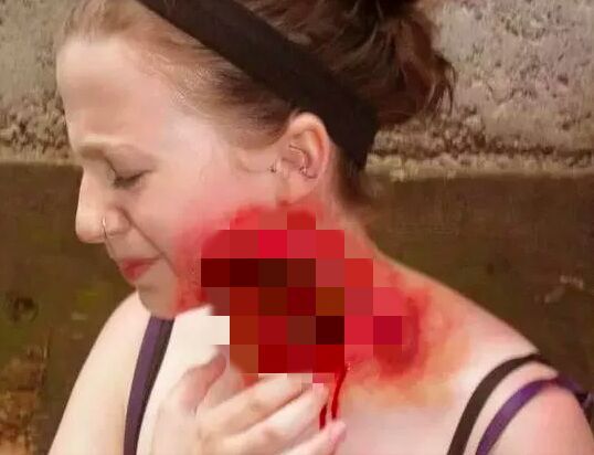 紧急！全澳多地出现“吃人菌”，感染后如同丧尸！24小时可吃一人