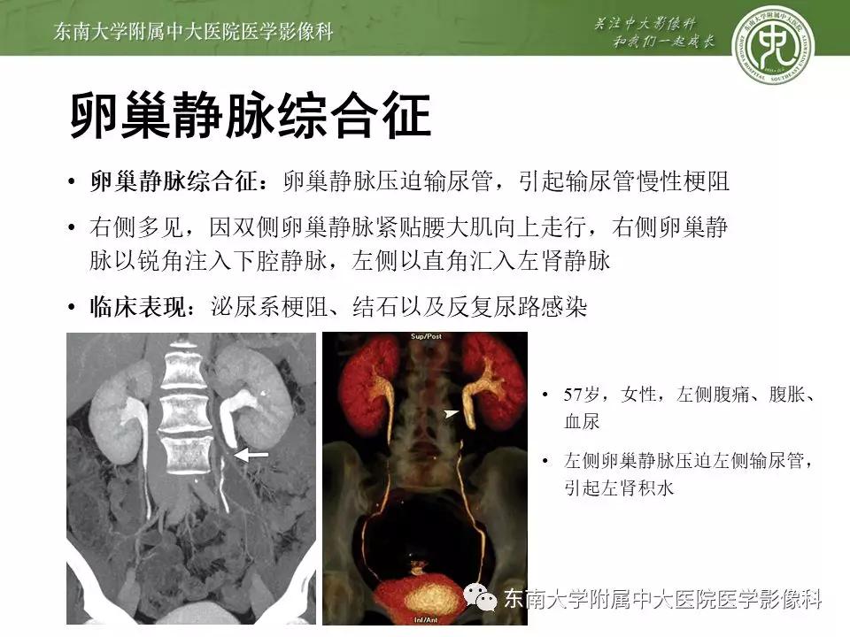 肠系膜上动脉压迫综合征挂什么科,肠系膜上动脉压迫综合征手术费用