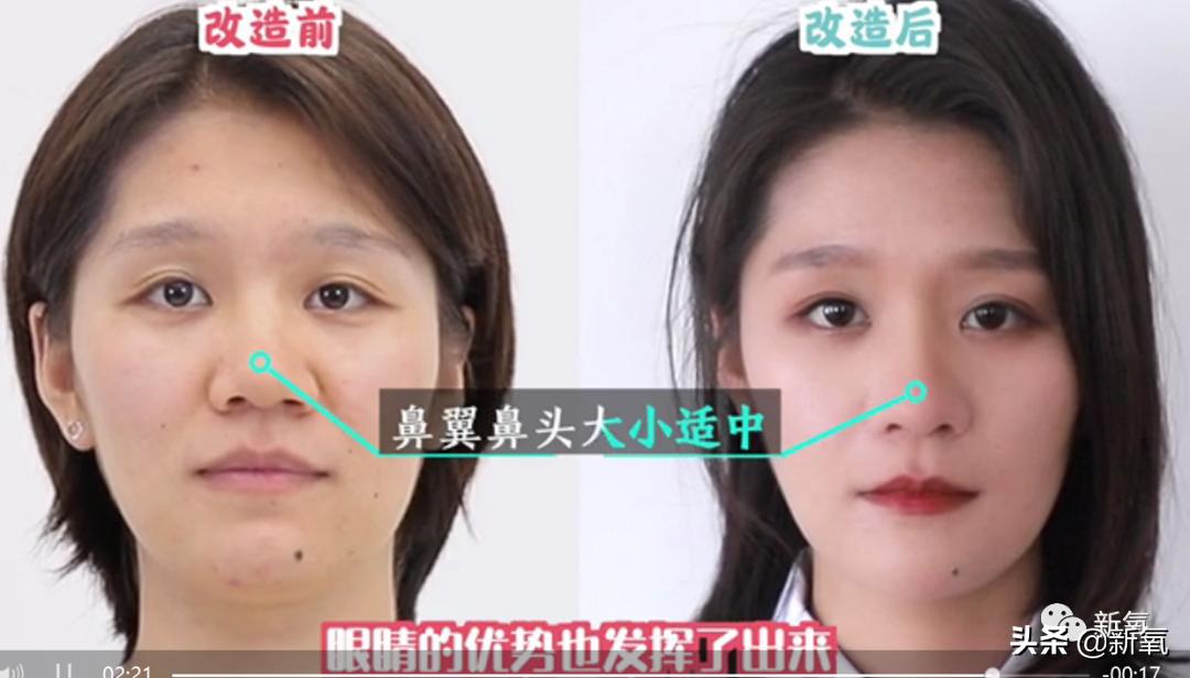 村姑整成鞠婧祎的鼻子变天使,鞠婧祎的鼻子整过吗