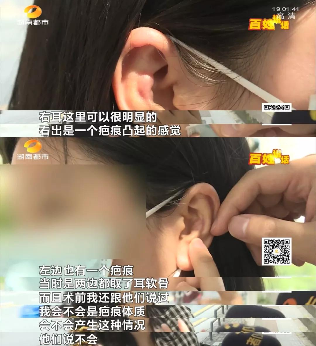 隆鼻微整形需谨慎,隆鼻整容需谨慎