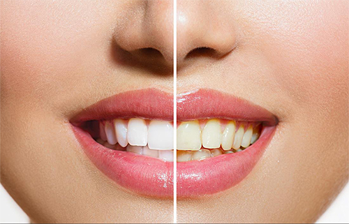 牙齿特别黄怎么刷也刷不白怎么办,牙齿发黄又很脏一个简单刷牙方法