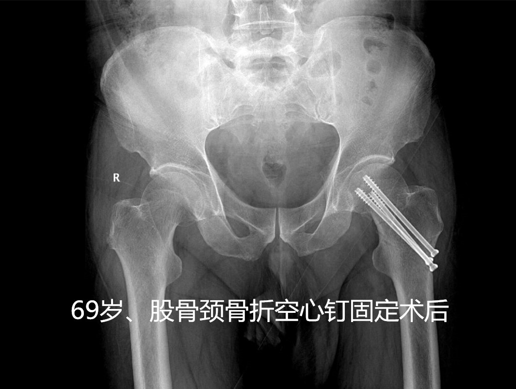 人生最后一次骨折怎么处理,老年髋部骨折是人生最后一次骨折