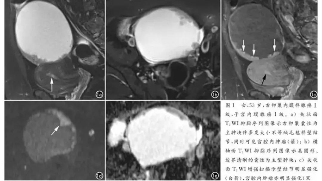 卵巢原发肿瘤的分析思路