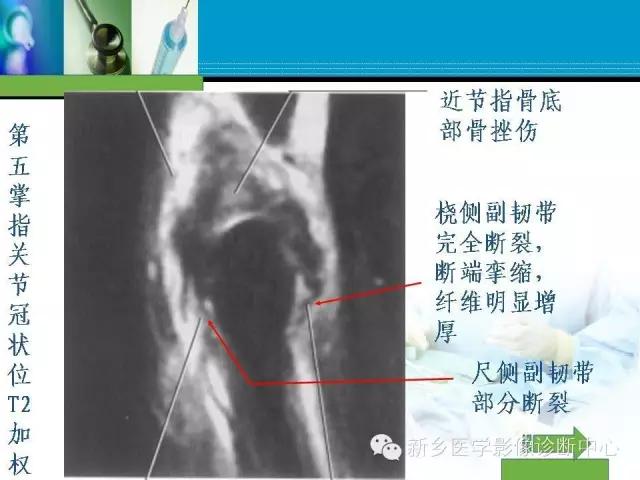 单只手指磁共振,手指用磁共振能做出来结果吗