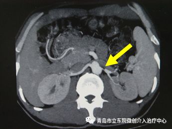 讲述一位高血压患者治愈经历,难治性高血压诊治图解