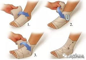 踝关节不稳的发生机制、康复训练及预防