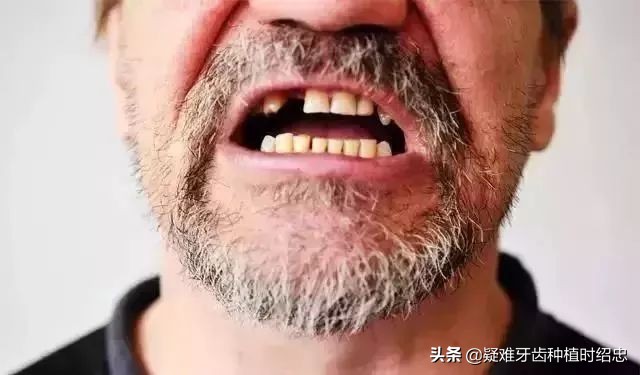 做种植牙必须要具备这些条件,种植牙的缺点哪些人不适合种植牙