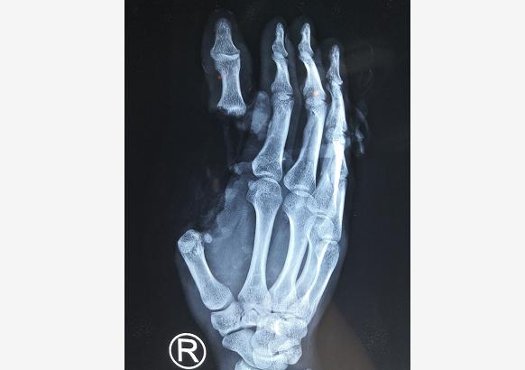 有智力障碍该怎样治最好,得了智力障碍怎么办