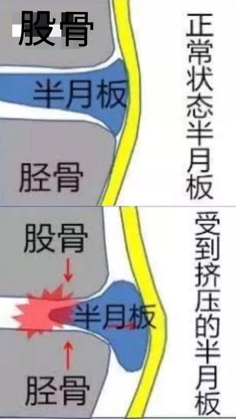 有效改善膝盖疼痛问题简单省钱,膝盖疼保护膝盖的3个方法