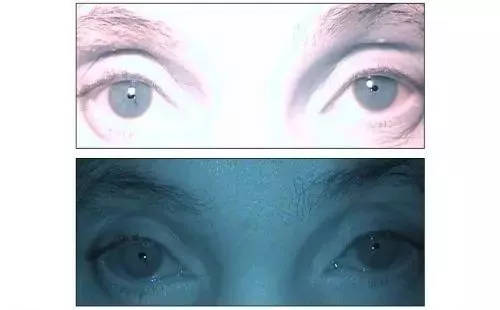 梅毒发作精神病,梅毒症状多久会发展成艾滋