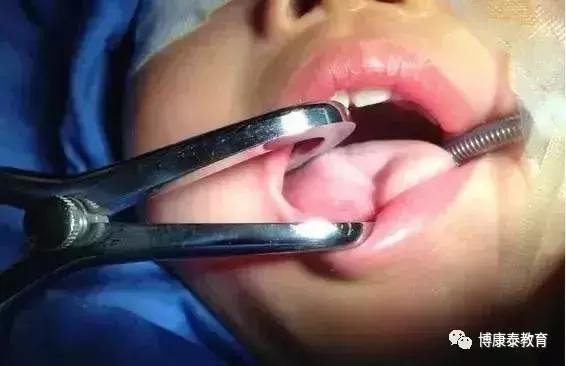 博康泰丨剪舌筋：该不该让孩子挨这一刀？