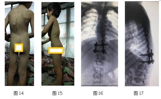 特发性脊柱侧凸的康复治疗方法,先天性脊柱侧凸