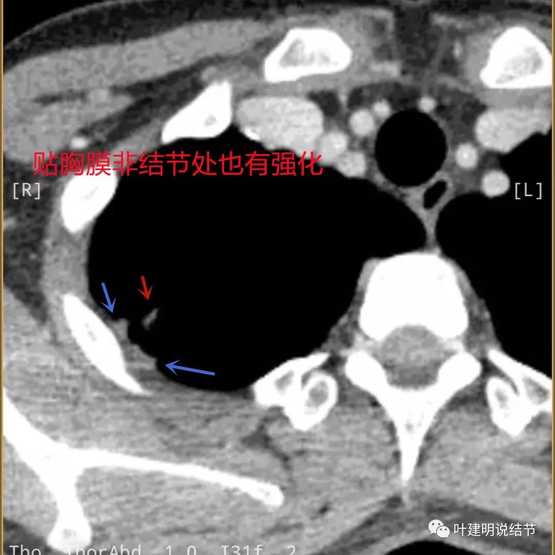 临床诊断孤立性肺结节,空洞型结节一般是什么性质