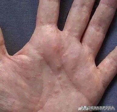 手上长密密麻麻水泡很痒涂什么药,手上起水泡脱皮瘙痒怎么回事