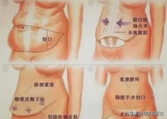 腹壁成形和剖腹产哪个手术更大,产后多久可以做腹壁成形手术