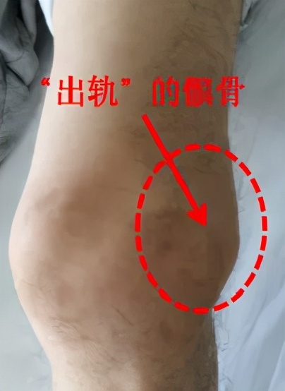 骨科医生教你一招搞定膝盖痛,不同部位膝关节