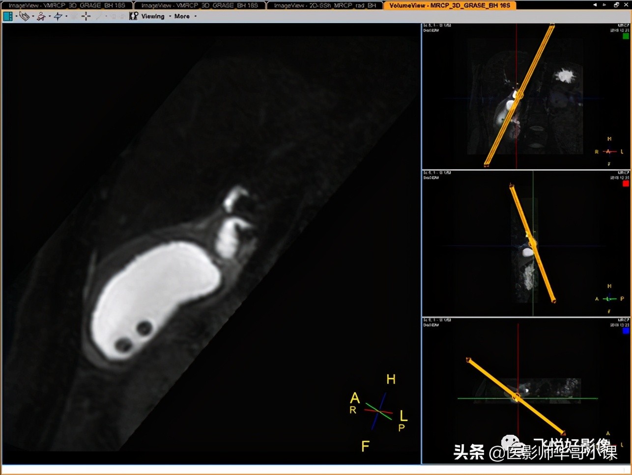 「飞利浦磁共振技术」胆道系统胆胰管水成像之3D_MRCP_BH