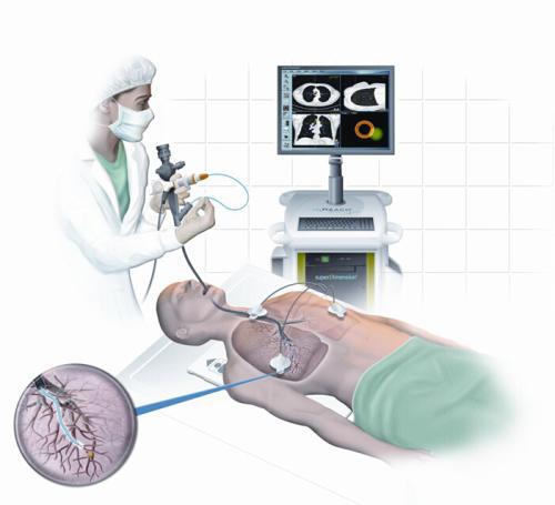 电磁导航微波消融肺结节费用,电磁跟踪手术导航仪