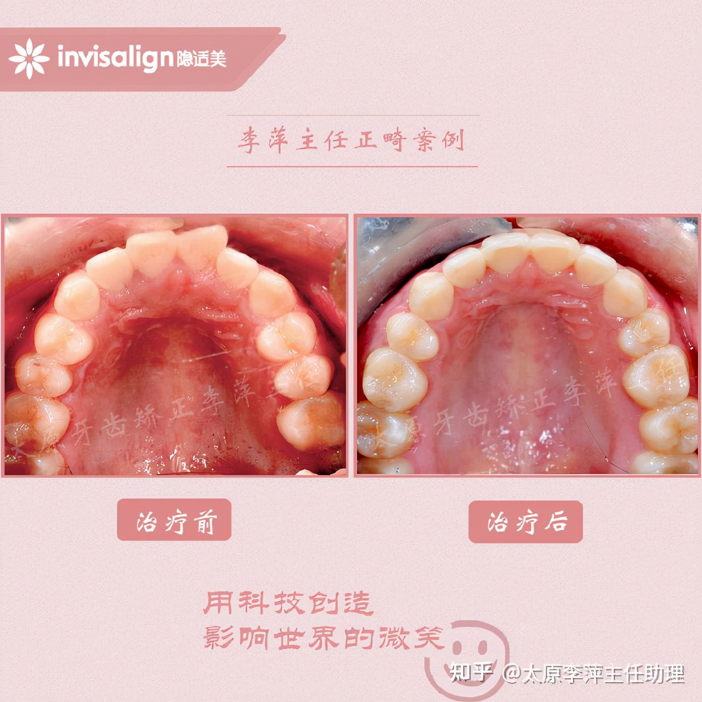 太原矫正牙齿需要做正颌吗,太原牙齿二次矫正