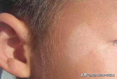 身上有白色斑但医生说不是白癜风,皮肤白斑和白癜风的区别