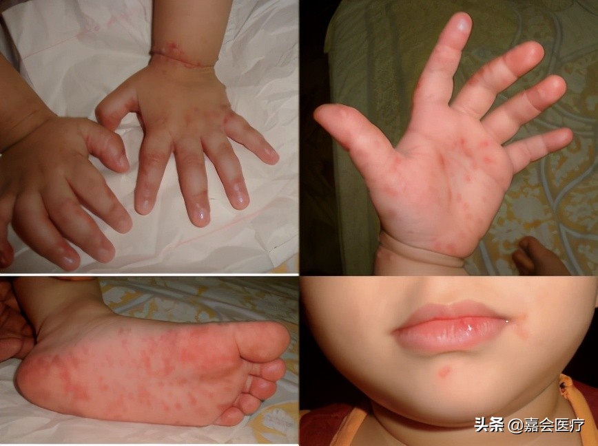 手足口病你必须知道,手足口病最新版知识解读