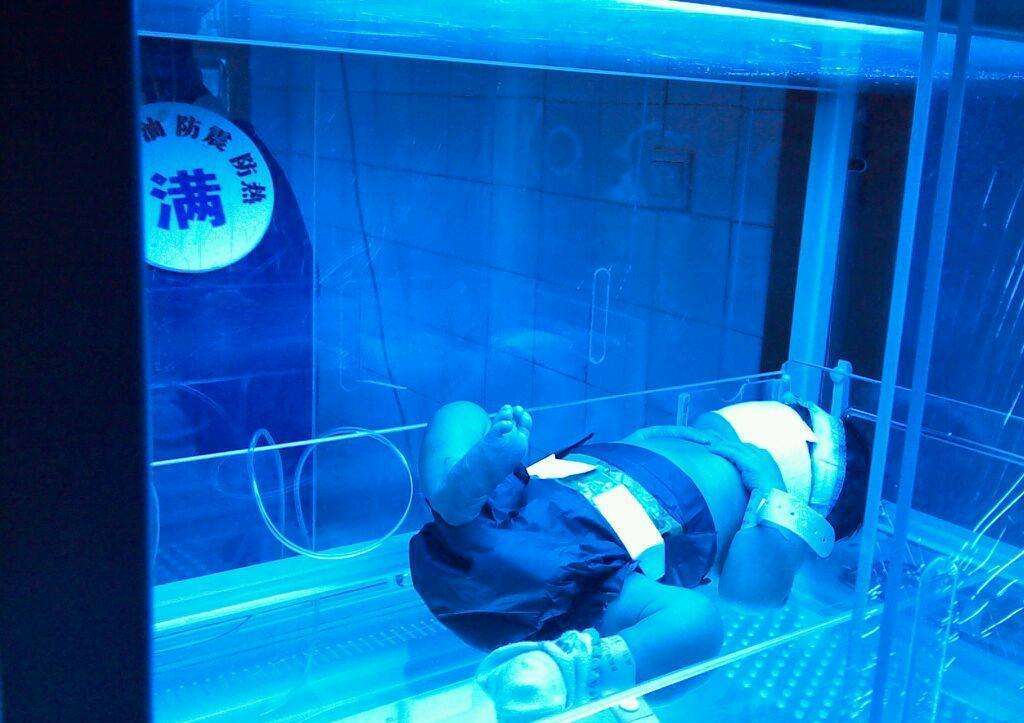 新生儿黄疸多少就该照蓝光,新生儿黄疸超过多少才需要照蓝光