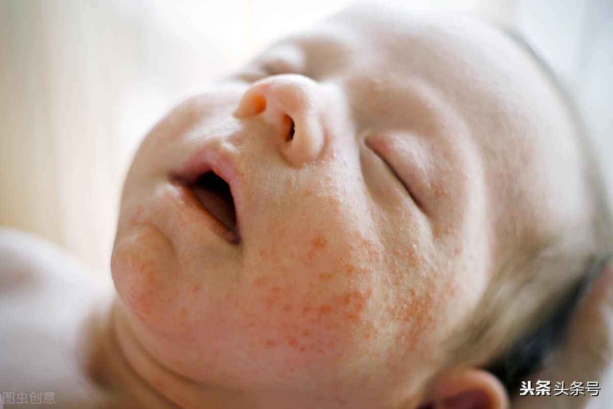 宝宝湿疹反复怎么办教你一招去除,宝宝湿疹反复发作一招解决