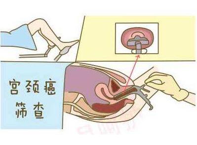 容易患上宫颈癌有哪些人群,年龄较小患上宫颈癌可能性大吗