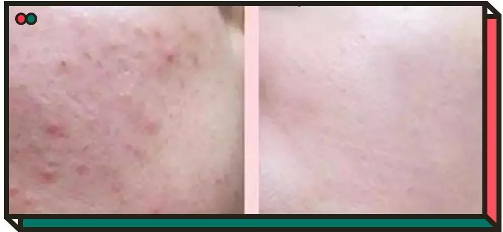 黛珂紫苏水祛痘,黛珂紫苏水祛痘吗