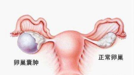 我检查出来有卵巢囊肿问题严重吗,最近检查肝有囊肿我好烦咋办