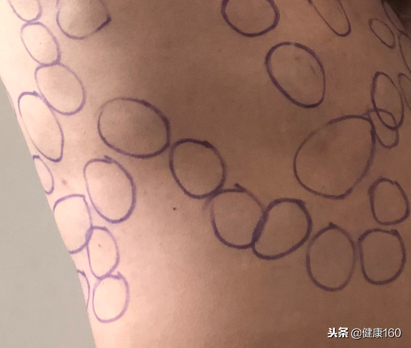 皮肤起小肉球怎么回事,大腿皮肤下面有个小肉球