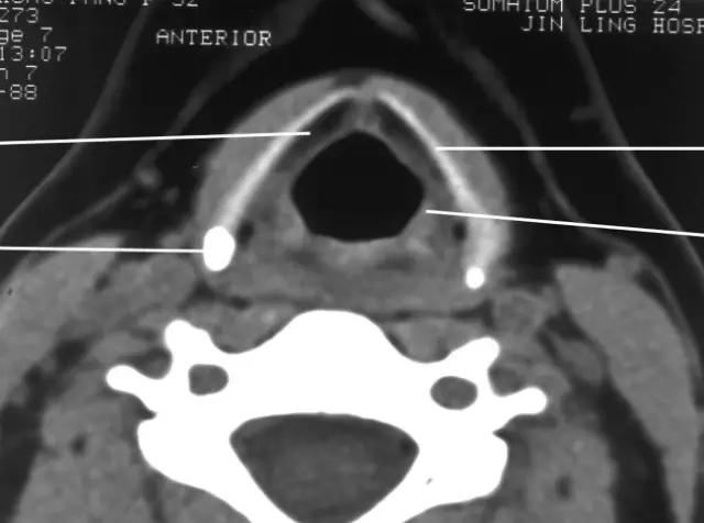 喉部病变做核磁还是ct,耳鼻喉科常见病影像诊断