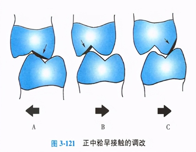 牙齿缺损粘接修复术和简单填充术,牙科义齿修复零基础教学