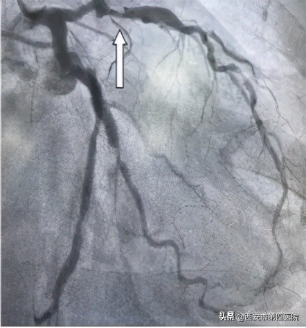 我院完成首例冠脉介入治疗,你是我的眼睛医院